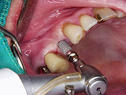 12_Implantat_14_transgingival.jpg