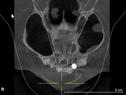 4-dvt-hor.sinus.jpg